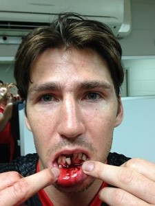 Perth Wildcats basketball player Damian Martin sustained a jaw fracture