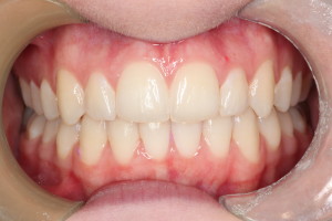 Invisalign treatment cosmetic dentist Perth