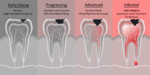 tooth decay dentist Claremont Perth dental cosmetic dentistry Perth