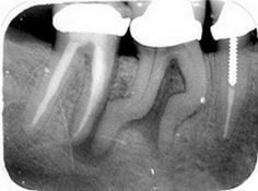 dental x-rays are they necessary dentist Claremont Perth dentist