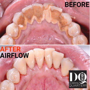 Before & After AIRFLOW EMS Claremont dentist Claremont dental Perth dentistry