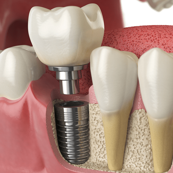 Dental Implant Procedure by Dental Quarters