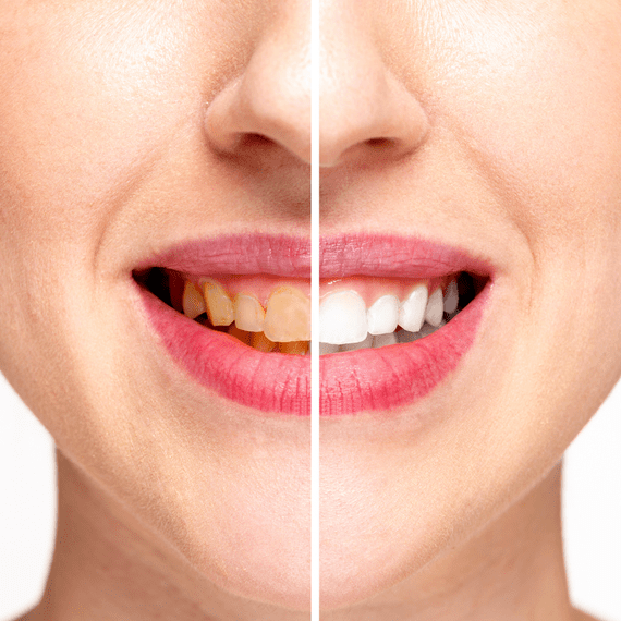 Dental Quarters - Our Teeth Whitening Process Perth