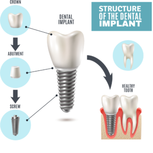 dental implants cost perth dentist Claremont dental