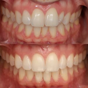 Invisalign clear aligners Perth Claremont cosmetic dentistry