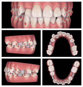 LH1 Invisalign case study Claremont dentist Perth Invisalign (1)