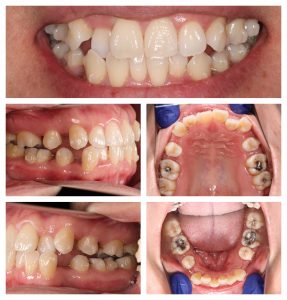 LH1 Invisalign case study Claremont dentist Perth Invisalign (2)