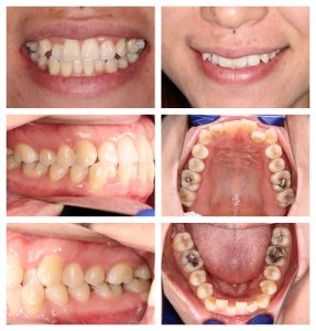 LH1 Invisalign case study Claremont dentist Perth Invisalign
