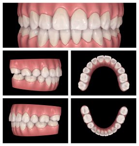 LH1 Invisalign case study Claremont dentist Perth Invisalign (3)