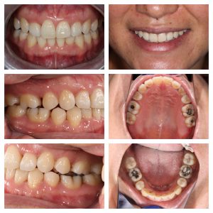 LH1 Invisalign case study Claremont dentist Perth Invisalign (4)