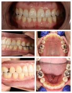 LH1 Invisalign case study Claremont dentist Perth Invisalign (5)
