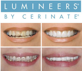 Lumineers Perth dentist Claremont dental Perth cosmetic dentistry