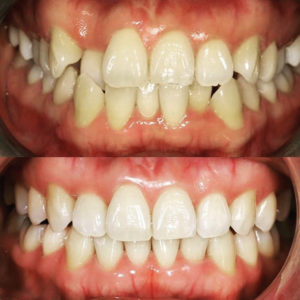 Perth Invisalign Claremont dental