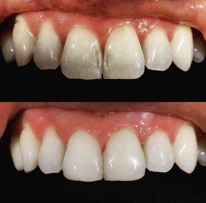 affordable cosmetic dentistry Claremont dental Perth dentist invisalign