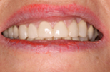 ann after Dentist Claremont Cosmetic Dentist Perth Claremont Dental