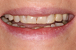 ann before Dentist Claremont Cosmetic Dentist Perth Claremont Dental
