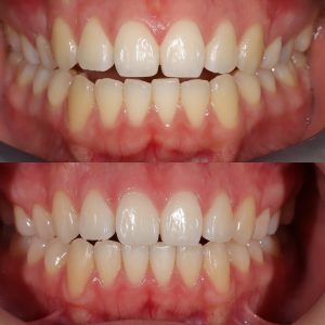 cosmetic dentistry Claremont Perth dentist Invisalign clear aligners Claremont dental