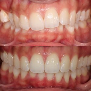 cosmetic dentistry Claremont Perth dentist Invisalign clear aligners clear braces