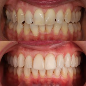 cosmetic dentistry Claremont Perth dentist Invisalign teeth straightening