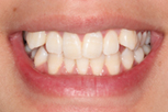 crystal before Dentist Claremont Cosmetic Dentist Perth Claremont Dental