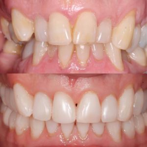 dentist Perth Invisalign Claremont dental