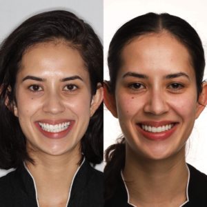 invisalign clear aligners before and after cosmetic dentist Claremont