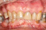 richard before Dentist Claremont Cosmetic Dentist Perth Claremont Dental