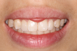 su-lin after Dentist Claremont Cosmetic Dentist Perth Claremont Dental