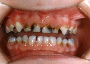 tooth decay children parents dentist Perth Claremont dental